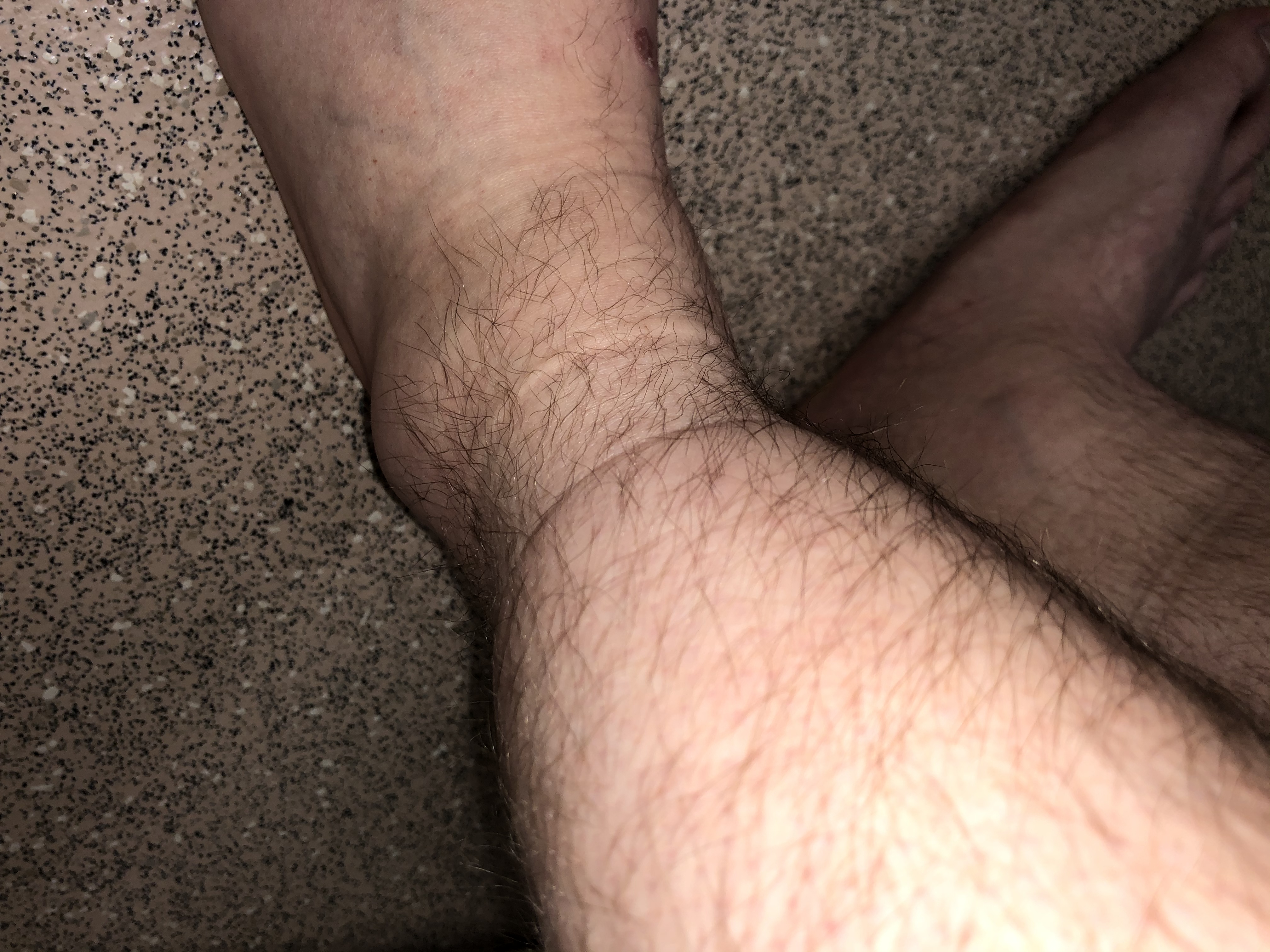 Medical Photo for: Benjamin Newton (24/04/1991)